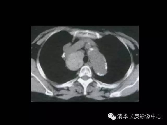【病例】胸内甲状腺肿1例CT影像表现