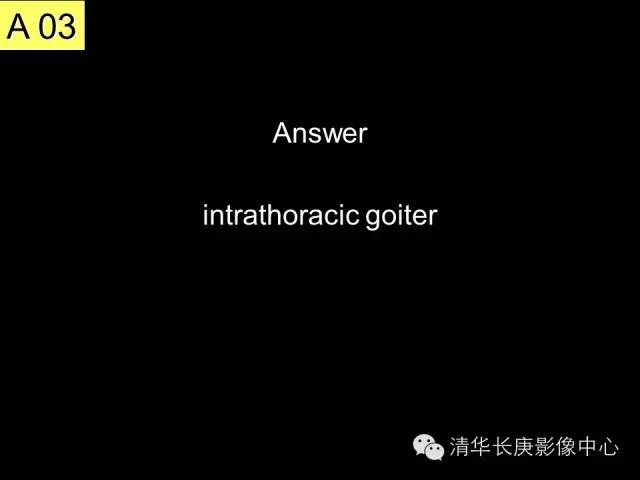 【病例】胸内甲状腺肿1例CT影像表现