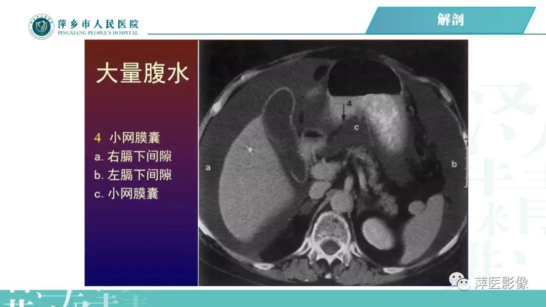 【PPT】腹腔游离气体-30