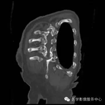 【病例】单侧肺动脉缺如1例