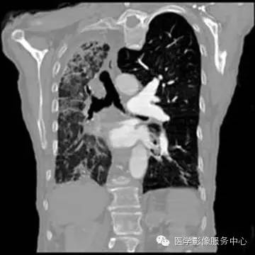 【病例】单侧肺动脉缺如1例