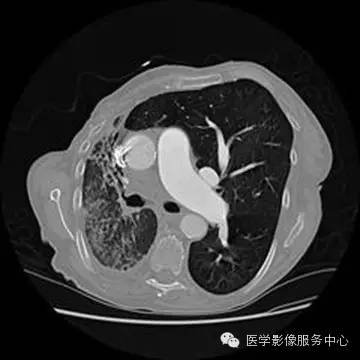 【病例】单侧肺动脉缺如1例