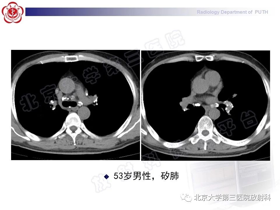 影像PPT - 【PPT】矽肺-21