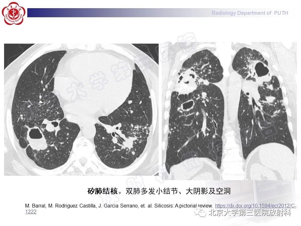 影像PPT - 【PPT】矽肺-29