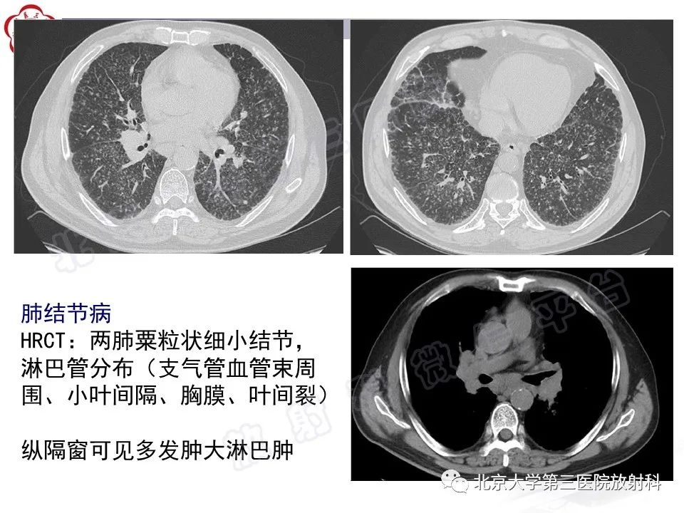 影像PPT - 【PPT】矽肺-39