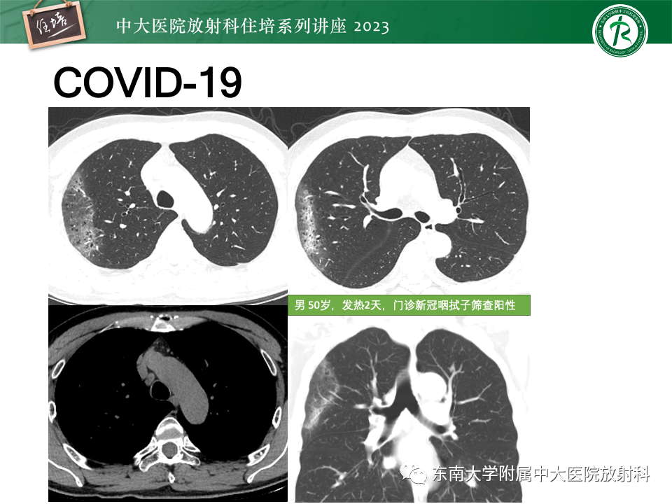 肺部特殊感染影像分析-47