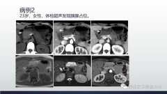 胰腺血管瘤1例CT及MR影像
