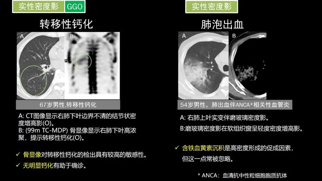 【PPT】肺部CT高密度病变诊断思路-44