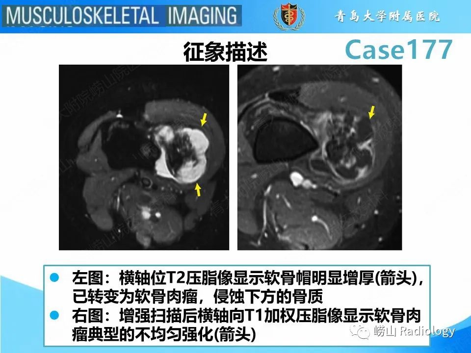 【PPT】骨软骨瘤-恶变-15
