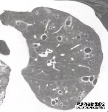 肺含气囊腔分类、定义及CT诊断思维-13
