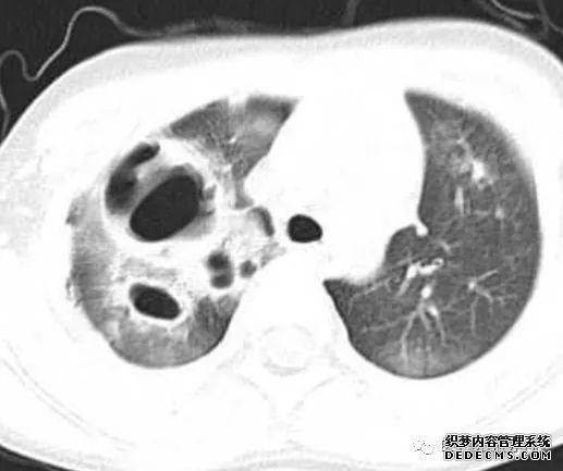 肺含气囊腔分类、定义及CT诊断思维-10