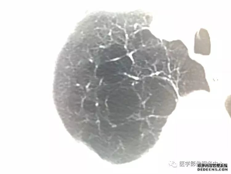 肺含气囊腔分类、定义及CT诊断思维-9