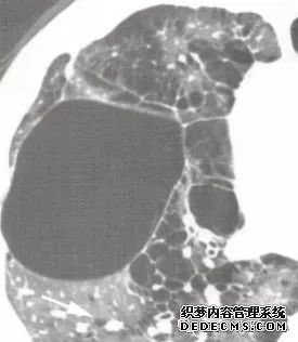 肺含气囊腔分类、定义及CT诊断思维-8