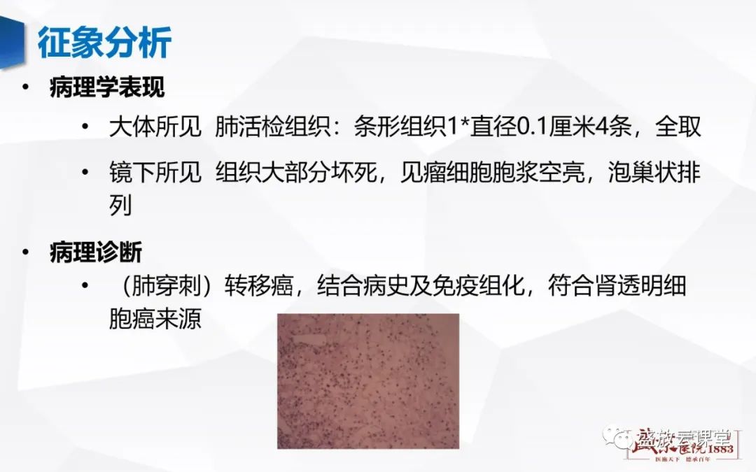 【病例】肺转移瘤1例CT影像-7