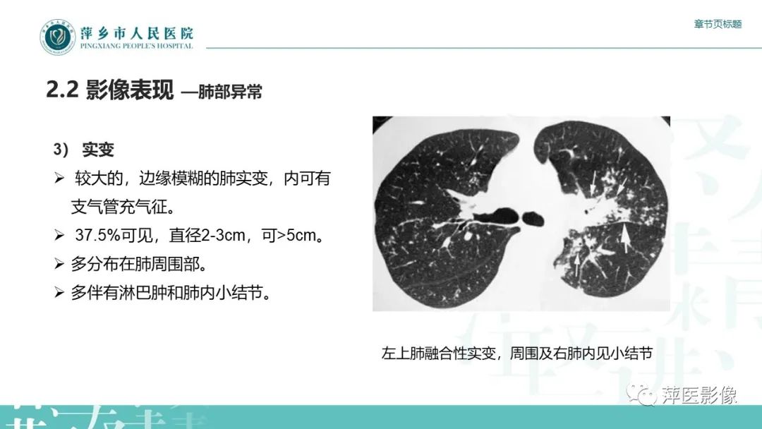 【PPT】肺结节病-13