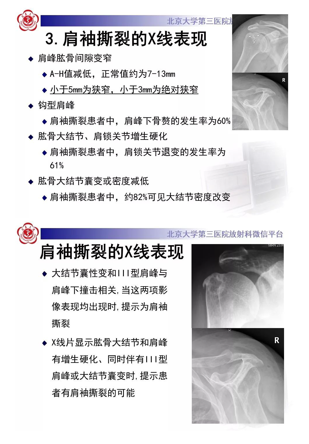 【PPT】肩袖疾病的X线检查及诊断-8