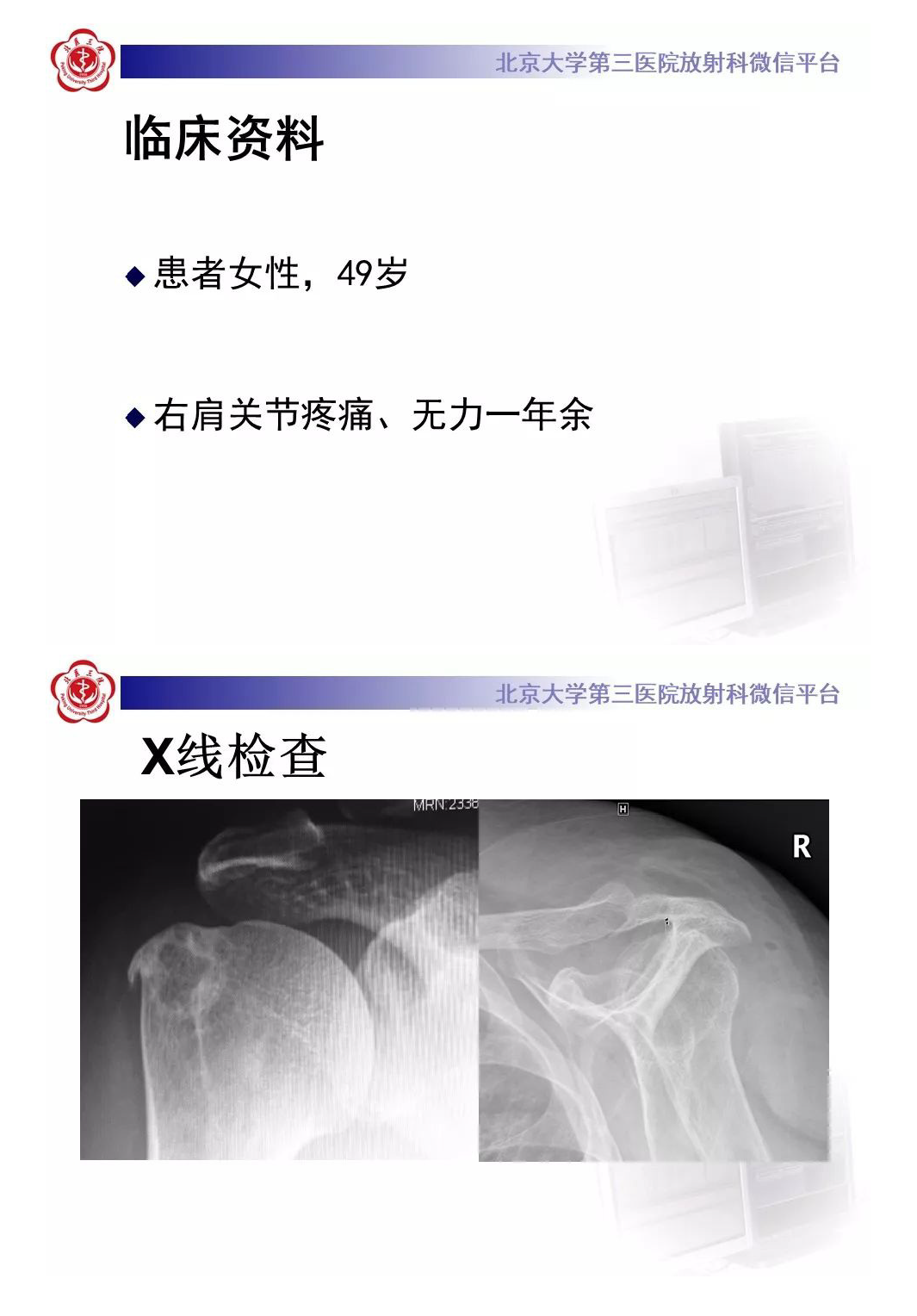 【PPT】肩袖疾病的X线检查及诊断-2