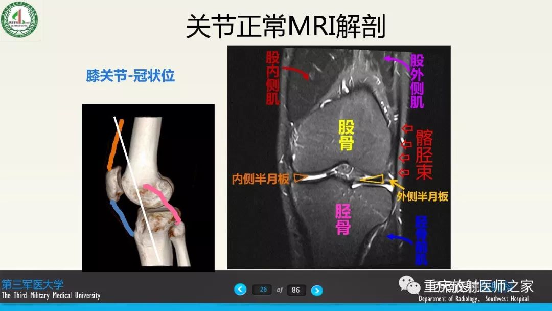 【PPT】膝关节韧带MRI诊断要点-26