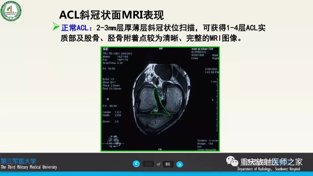 【PPT】膝关节韧带MRI诊断要点-61