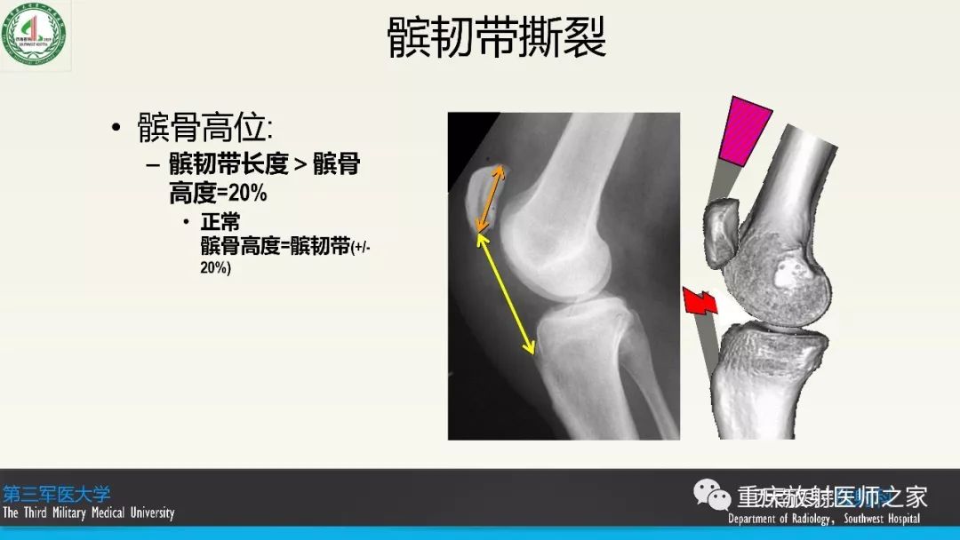 【PPT】膝关节韧带MRI诊断要点-76