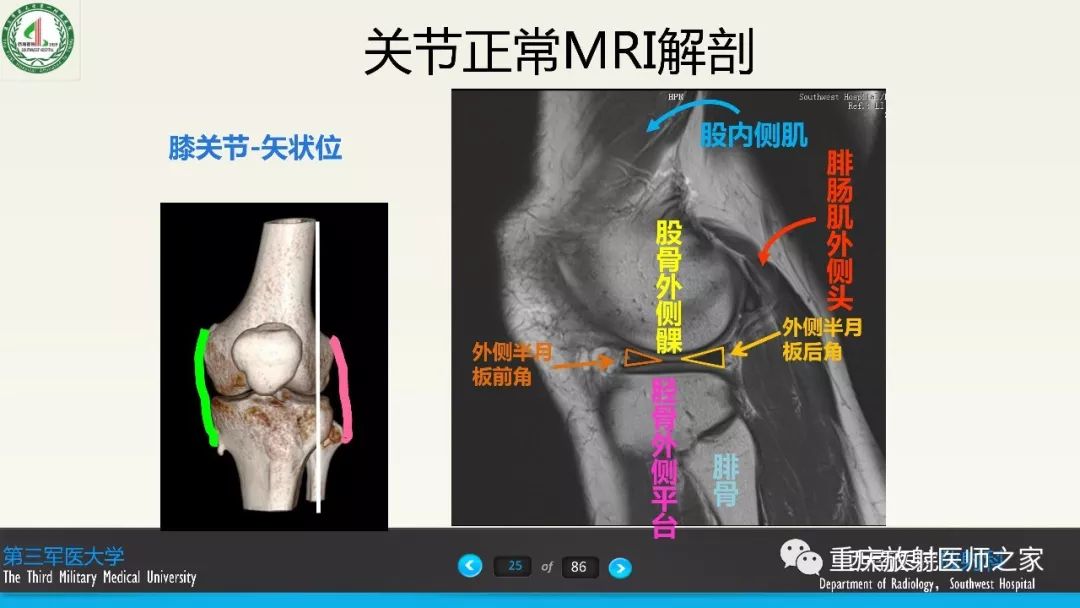 【PPT】膝关节韧带MRI诊断要点-25