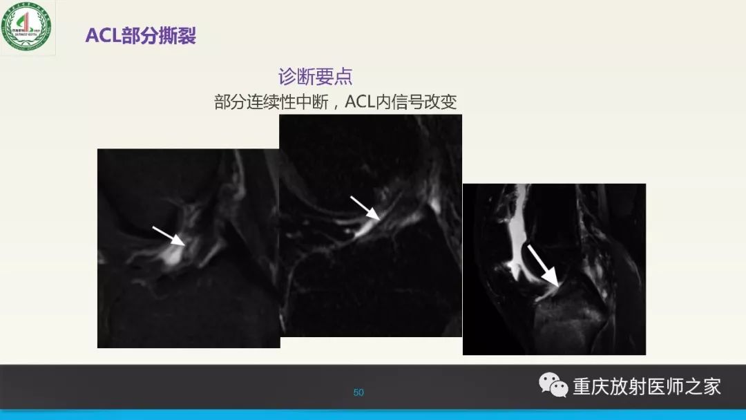 【PPT】膝关节韧带MRI诊断要点-50