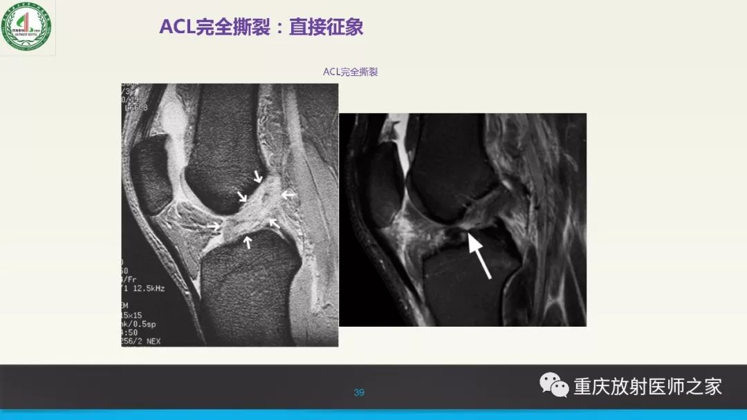 【PPT】膝关节韧带MRI诊断要点-39