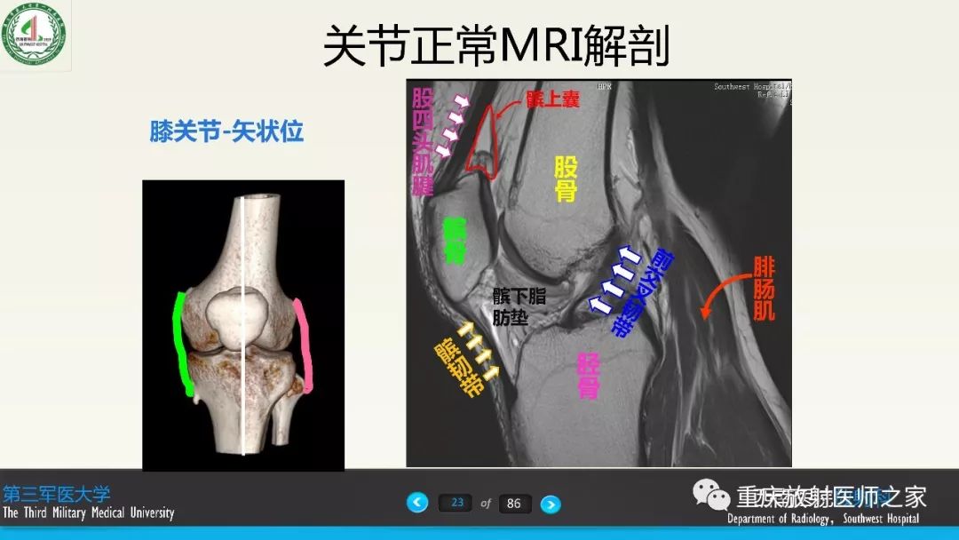 【PPT】膝关节韧带MRI诊断要点-23