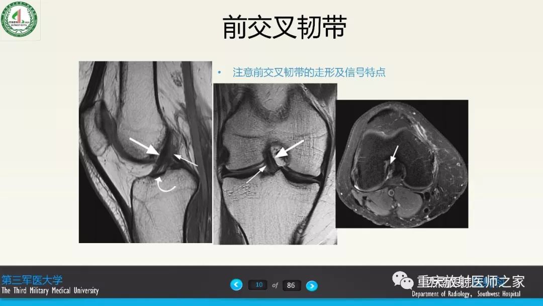 【PPT】膝关节韧带MRI诊断要点-10