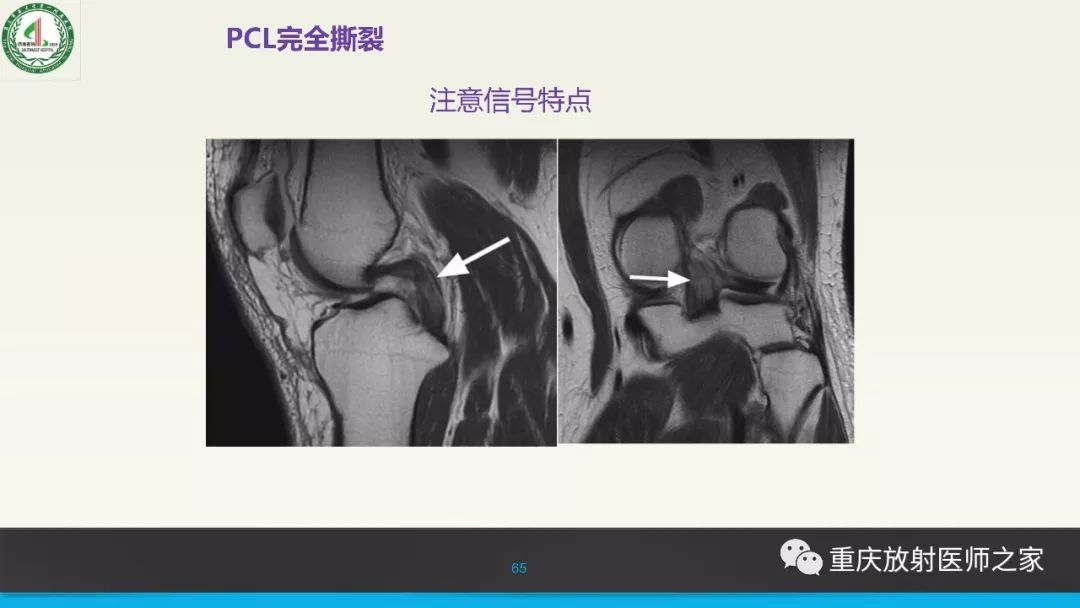 【PPT】膝关节韧带MRI诊断要点-65