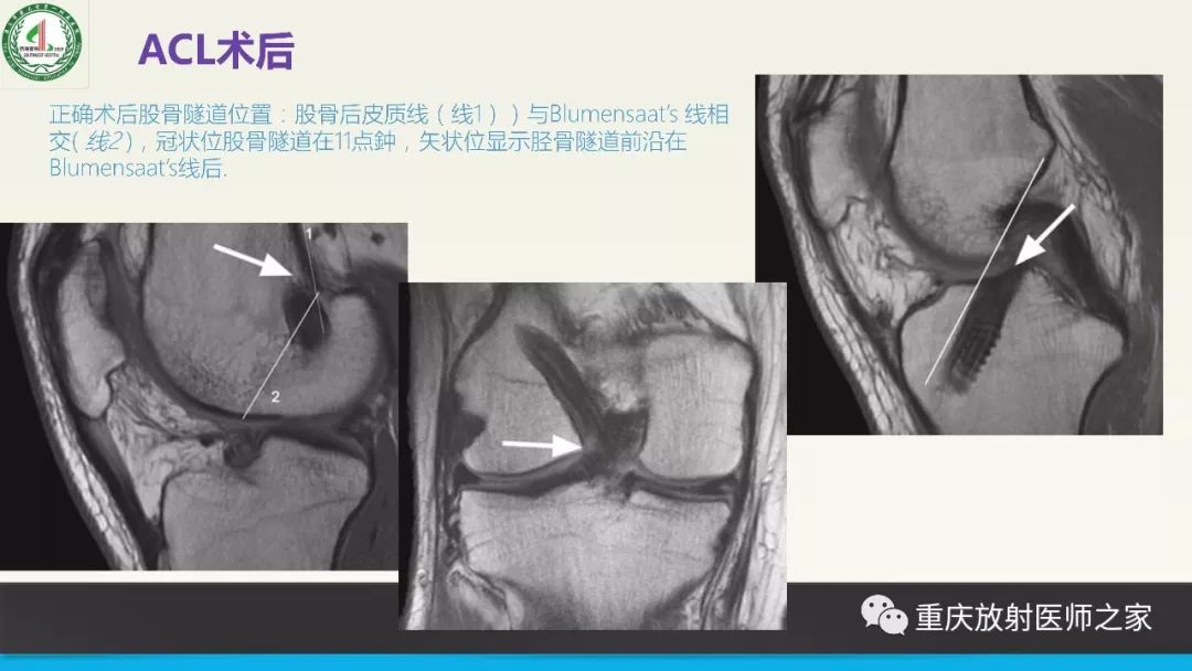 【PPT】膝关节韧带MRI诊断要点-79