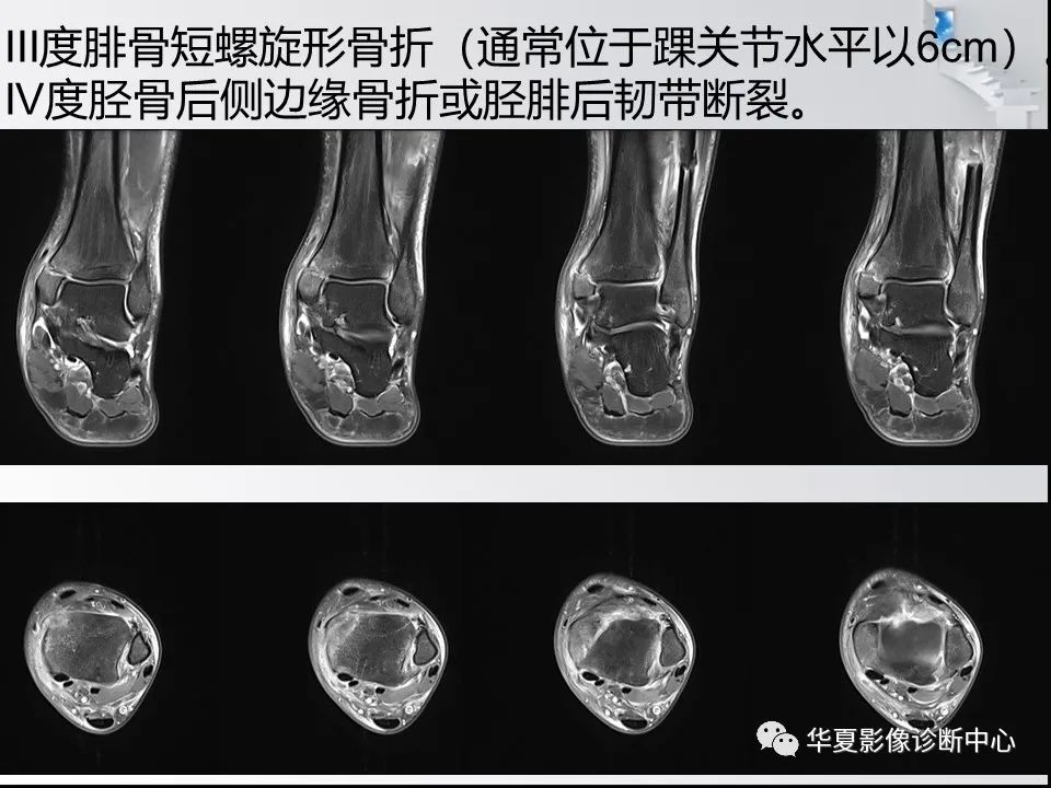 【PPT】踝关节韧带损伤MR表现与损伤机制分析-46