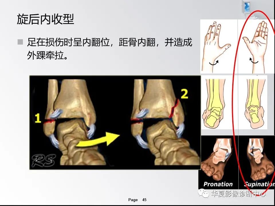 【PPT】踝关节韧带损伤MR表现与损伤机制分析-47