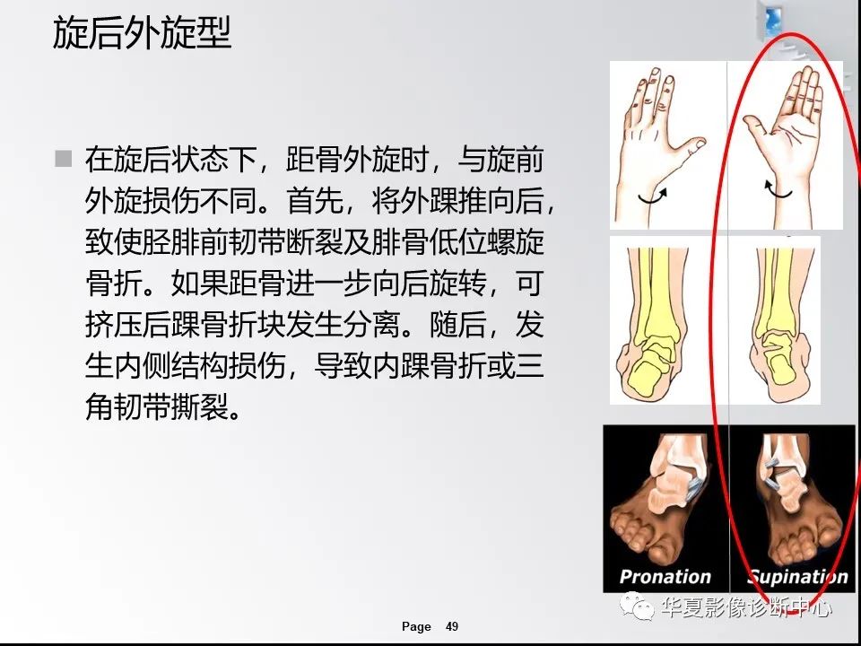 【PPT】踝关节韧带损伤MR表现与损伤机制分析-51