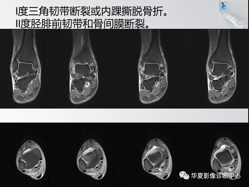 【PPT】踝关节韧带损伤MR表现与损伤机制分析-45