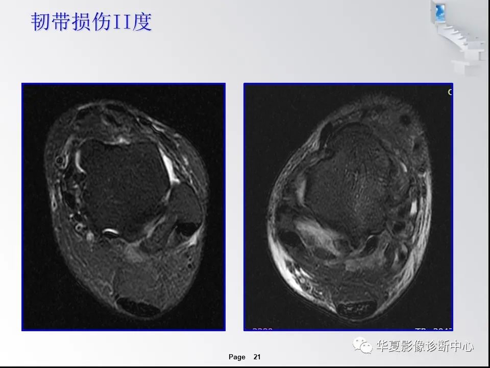 【PPT】踝关节韧带损伤MR表现与损伤机制分析-23