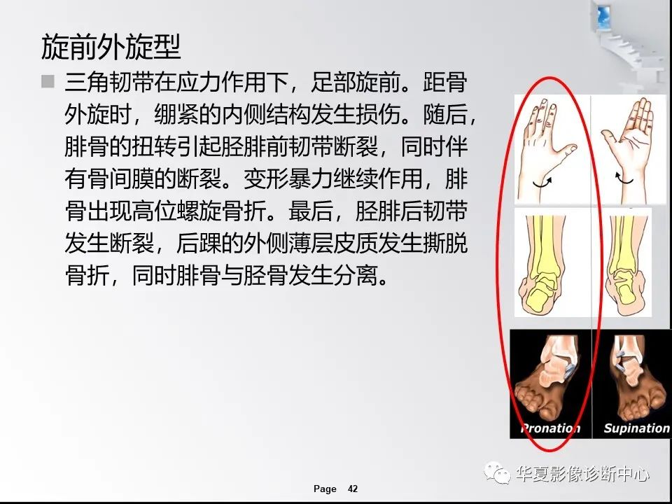 【PPT】踝关节韧带损伤MR表现与损伤机制分析-44