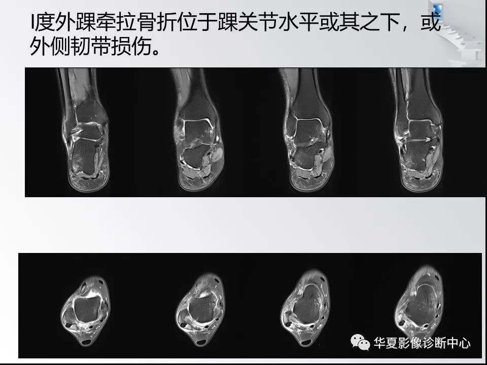 【PPT】踝关节韧带损伤MR表现与损伤机制分析-48