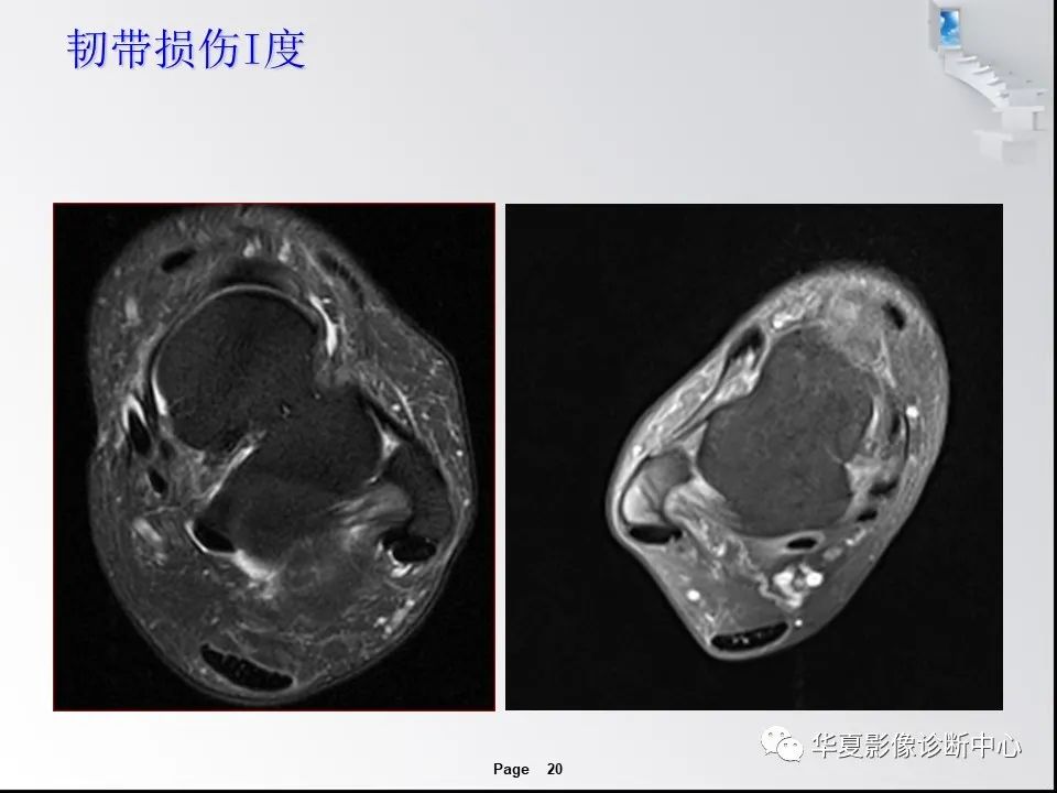 【PPT】踝关节韧带损伤MR表现与损伤机制分析-22