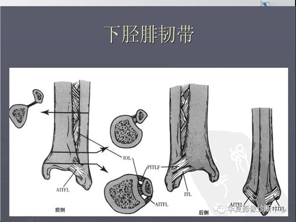 【PPT】踝关节韧带损伤MR表现与损伤机制分析-16