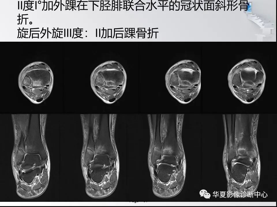 【PPT】踝关节韧带损伤MR表现与损伤机制分析-53