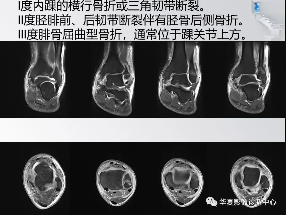 【PPT】踝关节韧带损伤MR表现与损伤机制分析-43