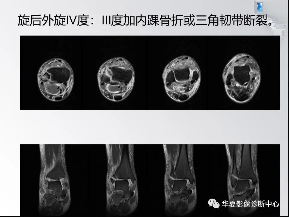 【PPT】踝关节韧带损伤MR表现与损伤机制分析-54