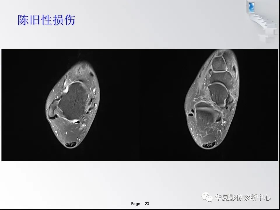 【PPT】踝关节韧带损伤MR表现与损伤机制分析-25