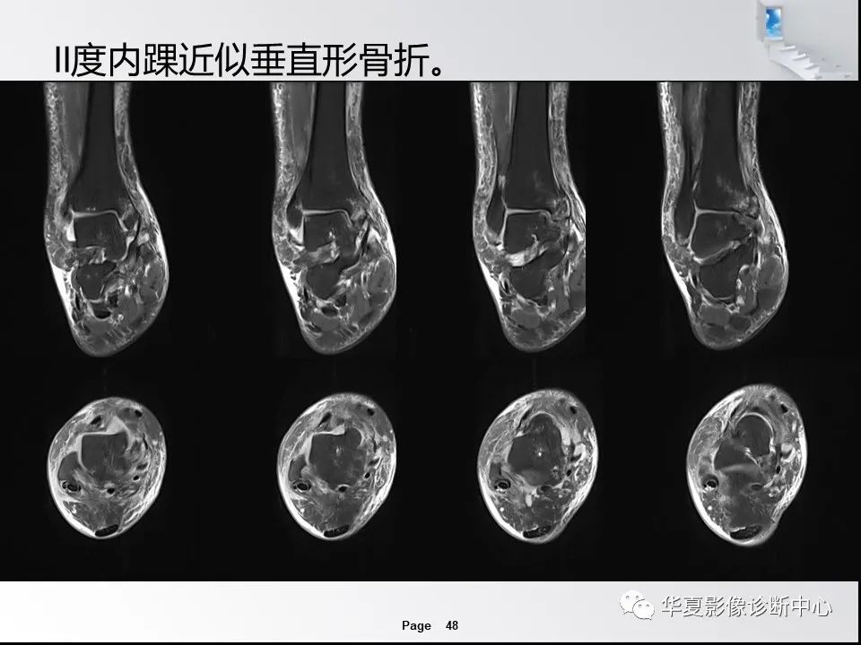 【PPT】踝关节韧带损伤MR表现与损伤机制分析-50
