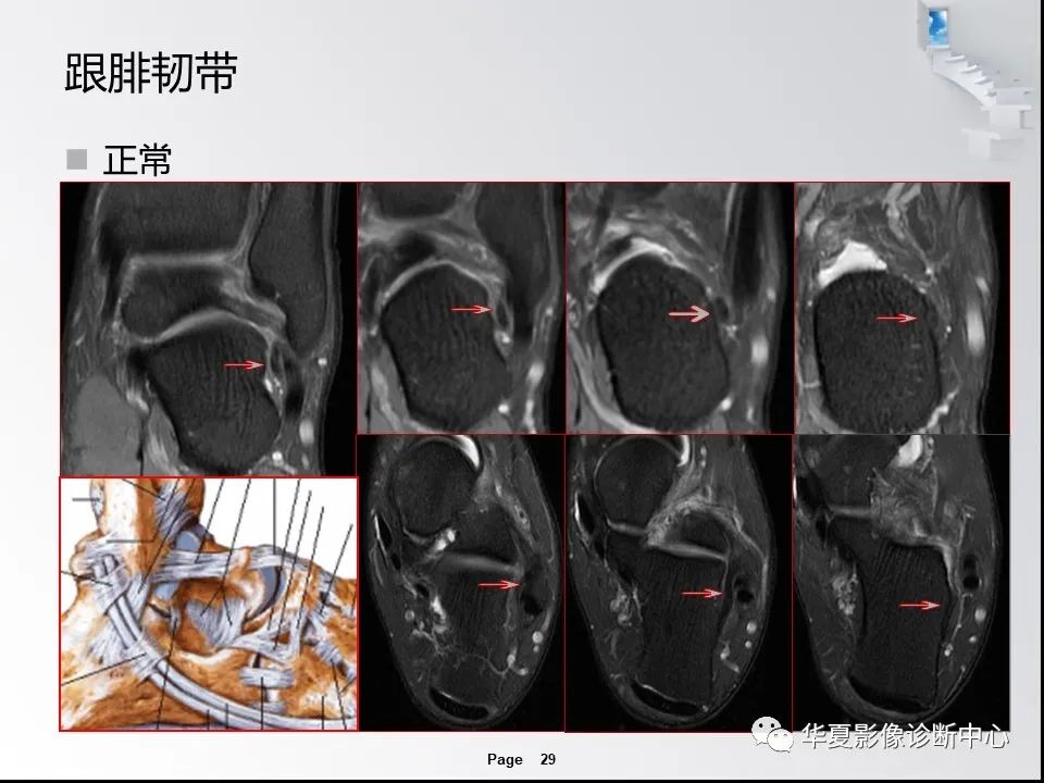 【PPT】踝关节韧带损伤MR表现与损伤机制分析-31