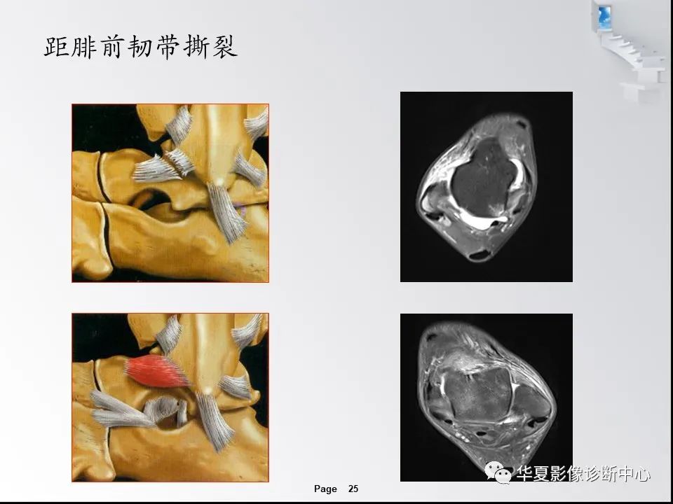 【PPT】踝关节韧带损伤MR表现与损伤机制分析-27
