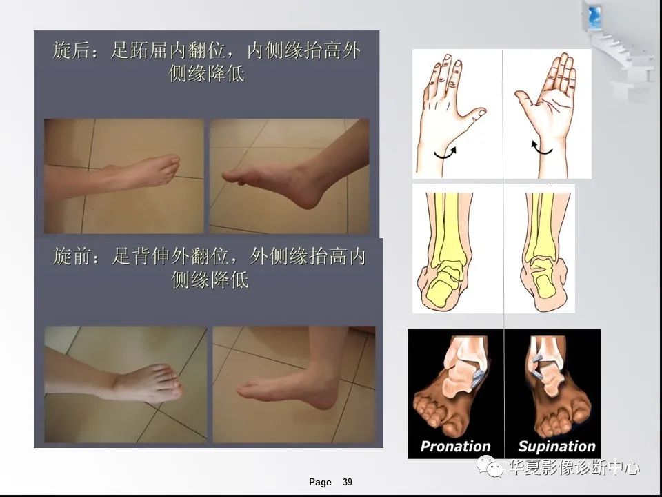 【PPT】踝关节韧带损伤MR表现与损伤机制分析-41