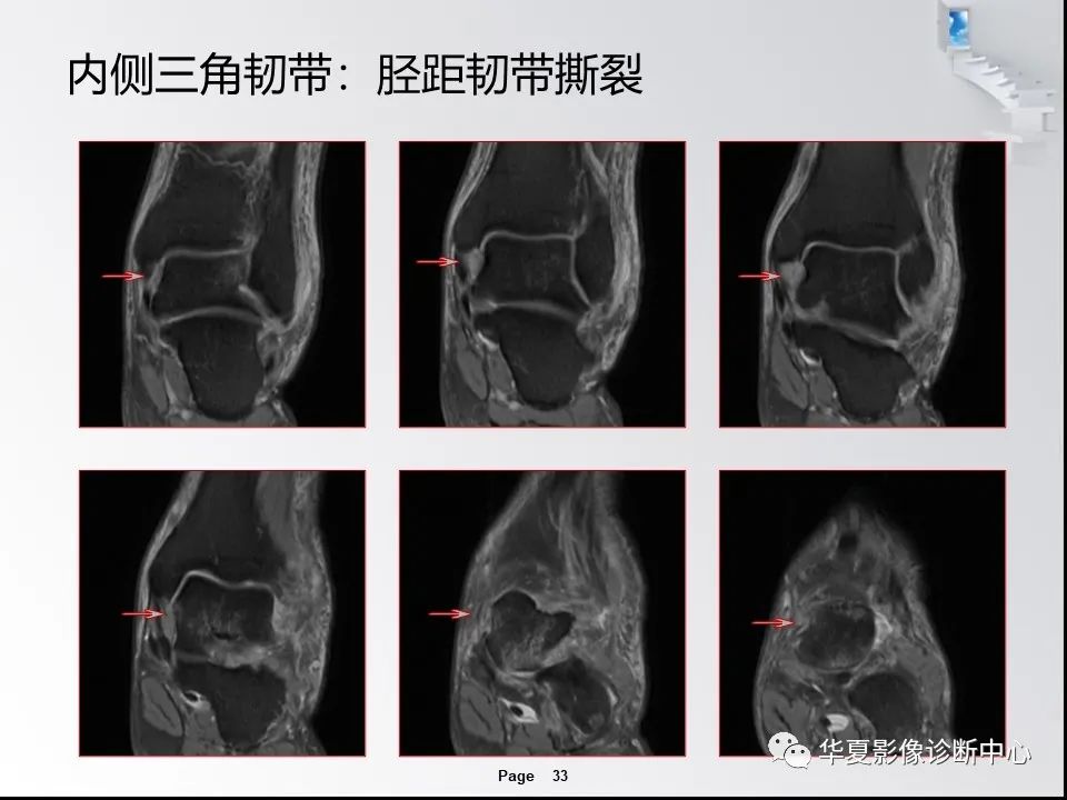 【PPT】踝关节韧带损伤MR表现与损伤机制分析-35
