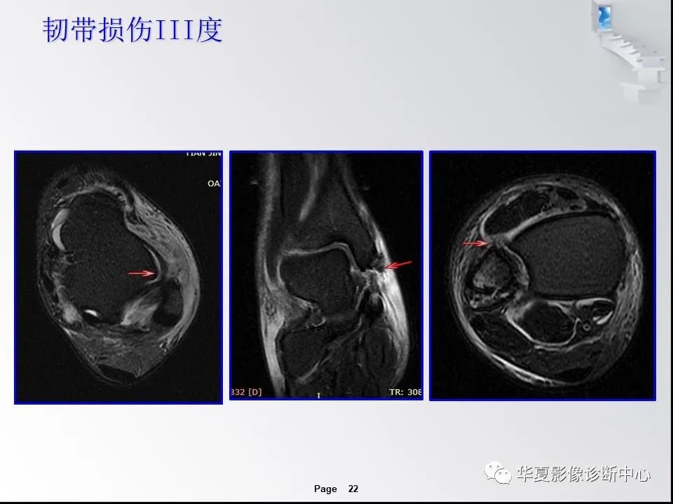 【PPT】踝关节韧带损伤MR表现与损伤机制分析-24